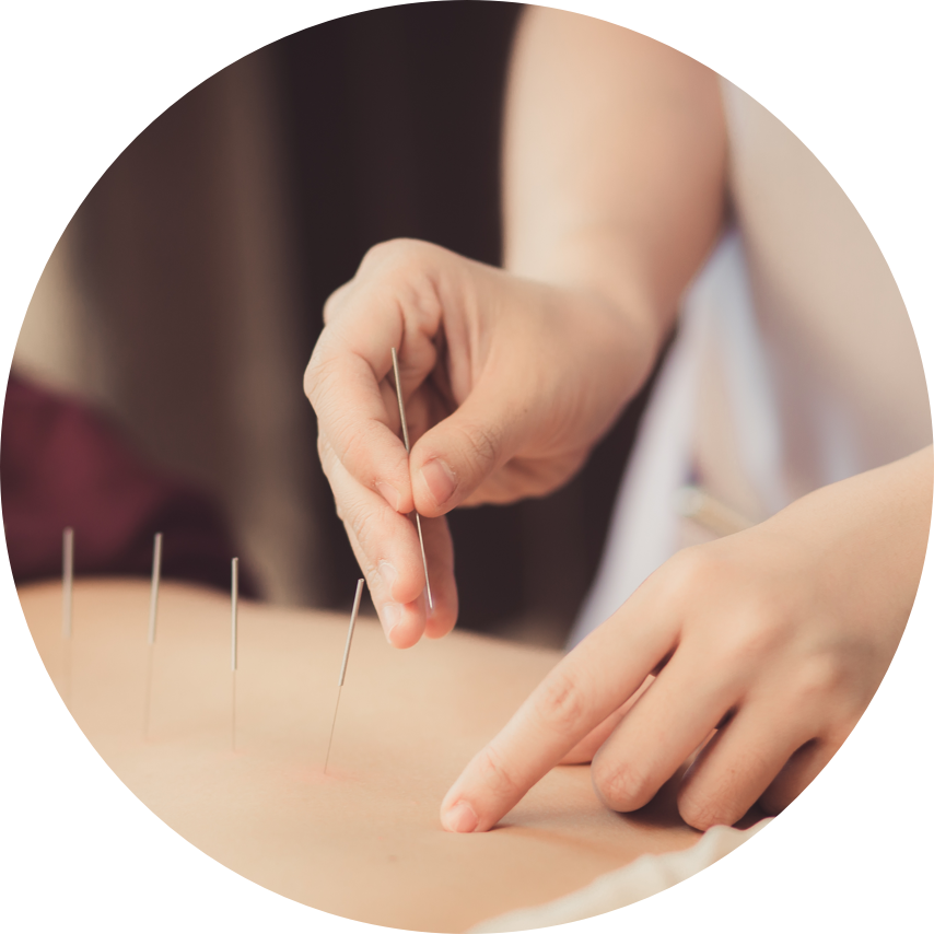 Santé Agile — Découvrez nos soins d'acupuncture